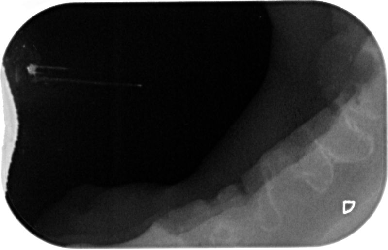 Fig.6 RX mandibola destra post-op