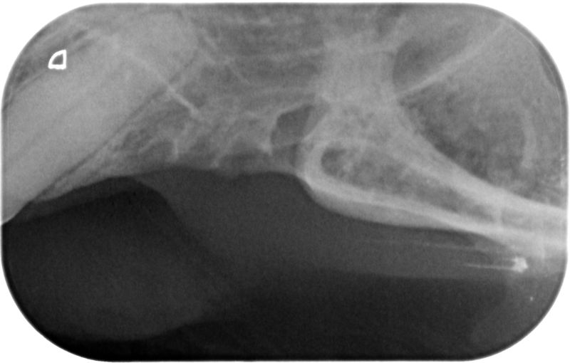 Fig.7 Rx mascella destra post-op