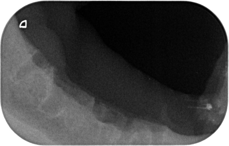 Fig.8 Rx manibola sinistra post-op